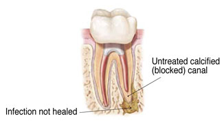 Endodontic_retreatment