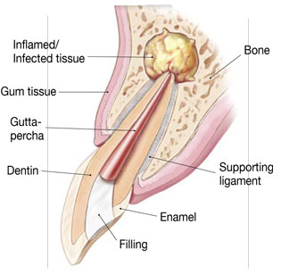 Endodontic_surgery