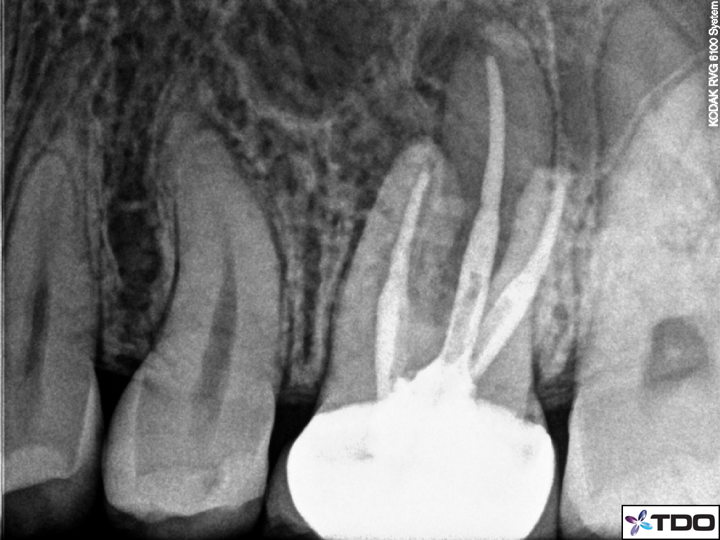 Eastlake Endodontics | Thermafil retreatment